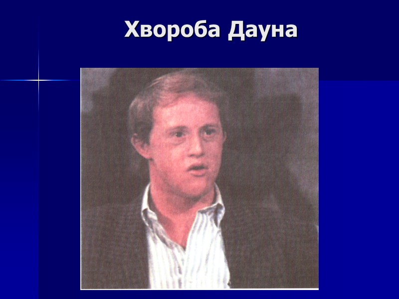 Хвороба Дауна